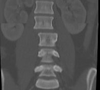Thoracolumbar Chance Fracture CT Coronal